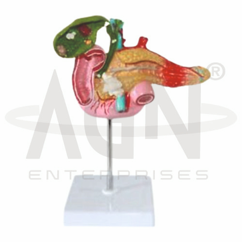 AJKANT Pathological Model Of The Pancreas (Model: AJK-BILA-13470)