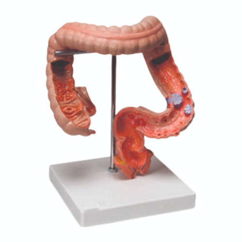 AJKANT Pathological Model Of Colon And Rectum (Model: AJK-BILA-12976)