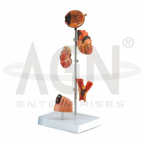 AJKANT Effects Of Diabetes (5 Parts) (Model: AJK-BILA-12774)