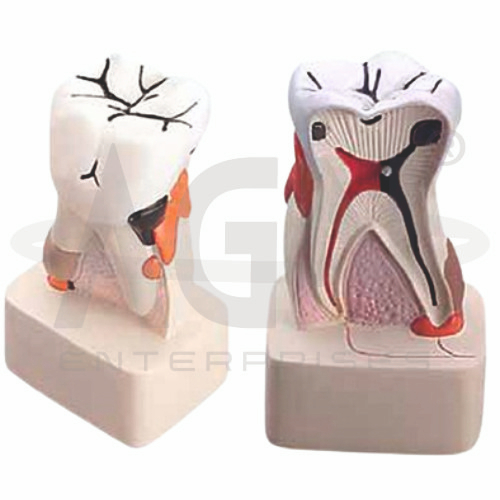 AJKANT Dental Pathology Model (Model: AJK-BILA-12749)