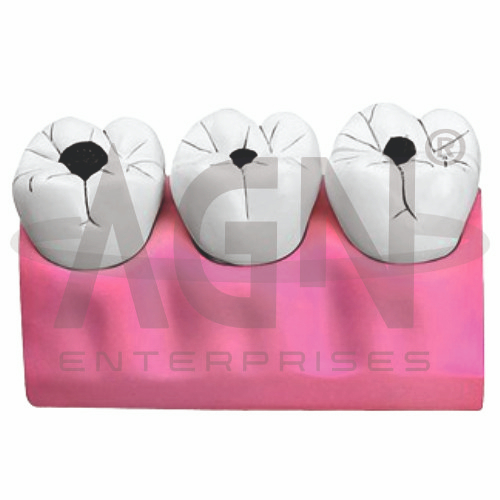 AJKANT Dental Caries Model (Model: AJK-BILA-12745)