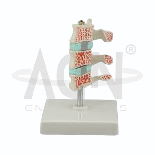 AJKANT Advanced Osteoporosis Model (Model: AJK-BILA-12687)