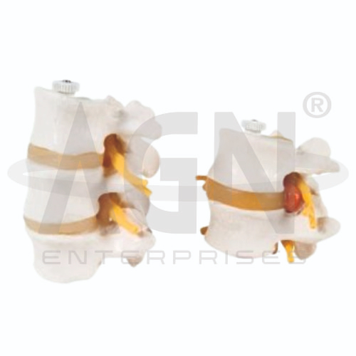 AJKANT 2 Lumbar Vertebrae/ 3 Lumbar Vertebrae (Model: AJK-BILA-12676)
